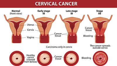 cervical cancer