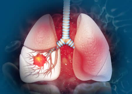 Lung Cancer