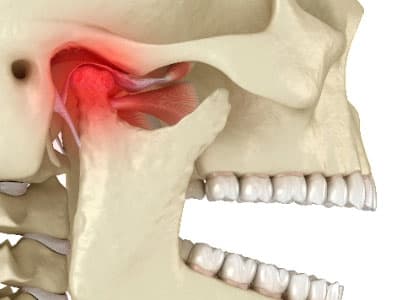 Close-up of skull showing Temporomandibular Joint