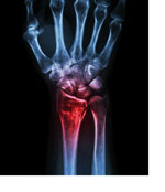 X-ray image of hand showing bone structure.