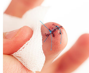 Finger with stitches