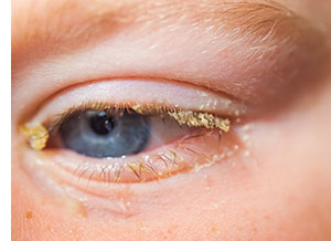 Classic symptoms of pink eye.