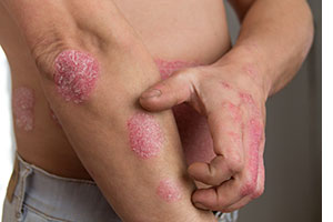 Man with bad skin rash.